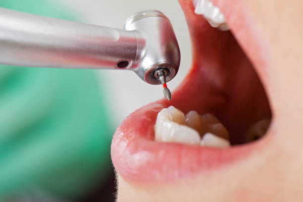Best Emergency Root Canal Treatment in Royal City, WA